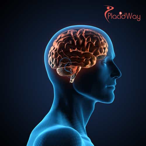 Brain Injury Stem Cell Therapy in Mexico: The Ultimate Guide for Medical Tourists